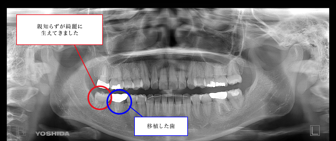 レントゲン治療：移植治療後