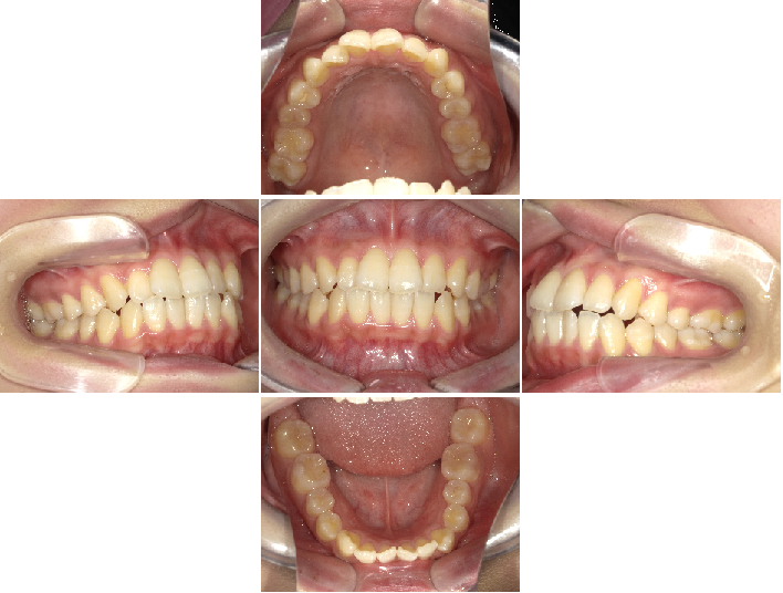 全顎矯正_矯正前