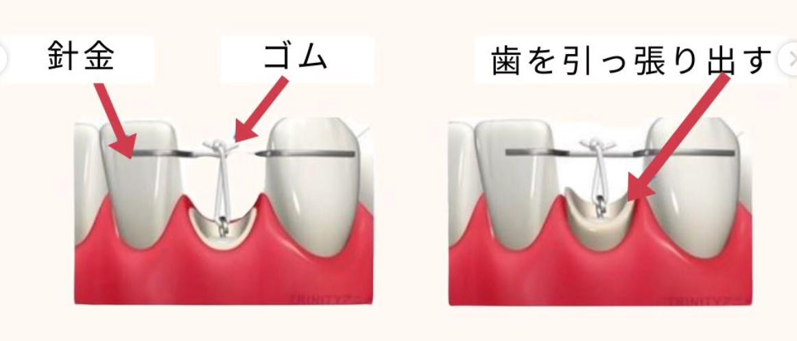 歯を矯正的に引っ張り出す①