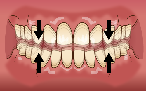 食べ物を噛む際の側方の力