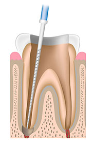 歯の根の神経の除去