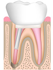 治療した歯を詰め物や被せ物で守る